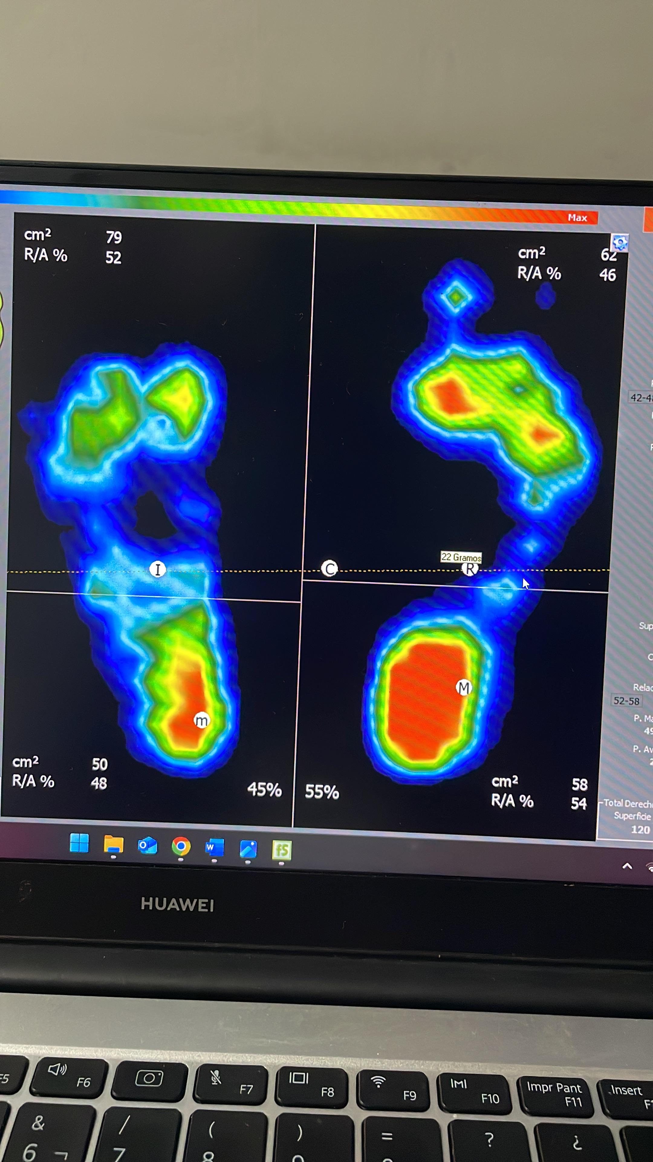 Mapa de Presión Plantar