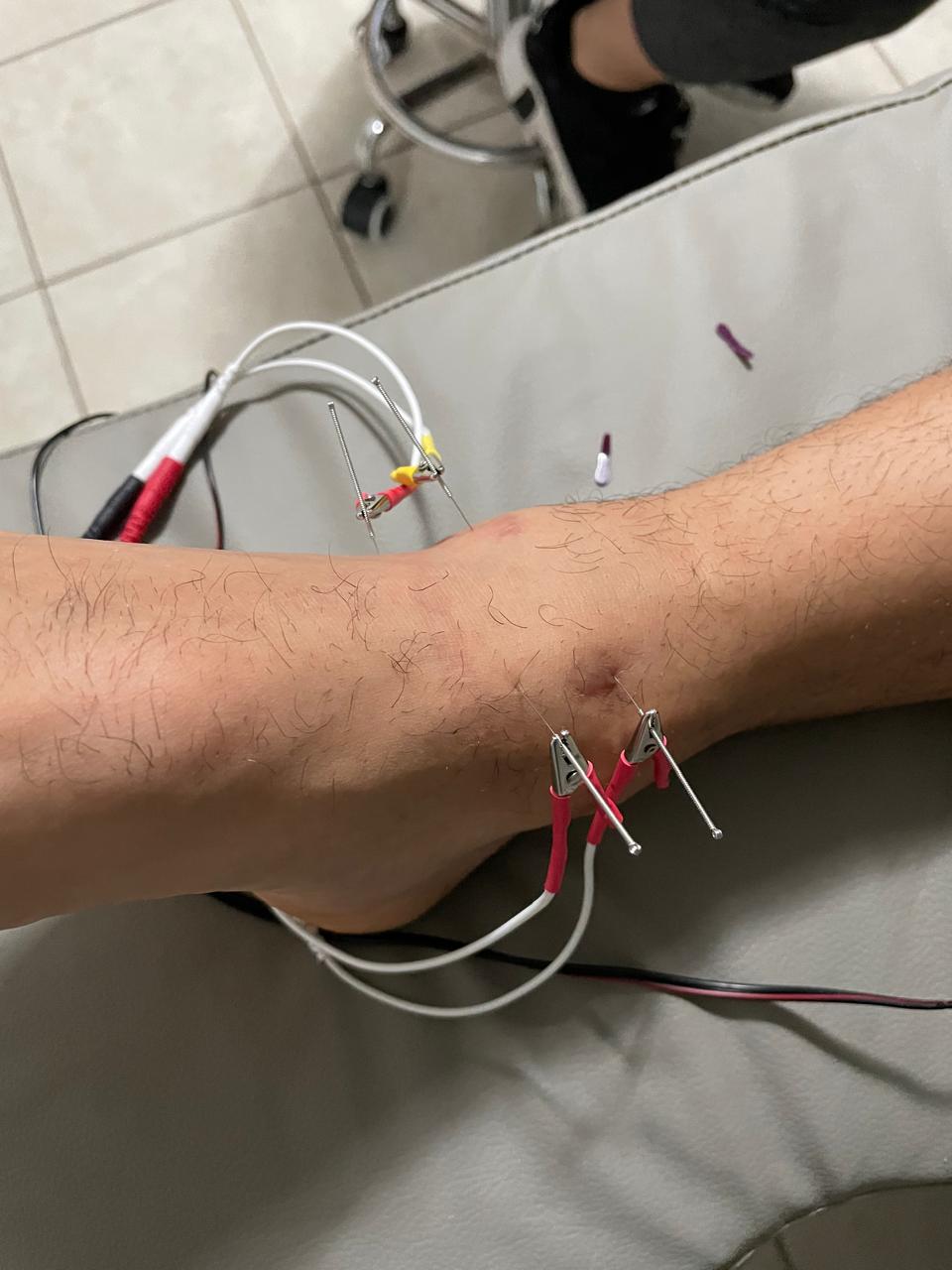 Electroestimulación